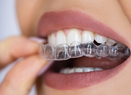 Apparecchio Invisibile | Studio Dentistico Demetra