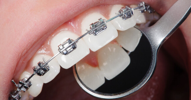 Apparecchio per i Denti | Studio Dentistico Demetra