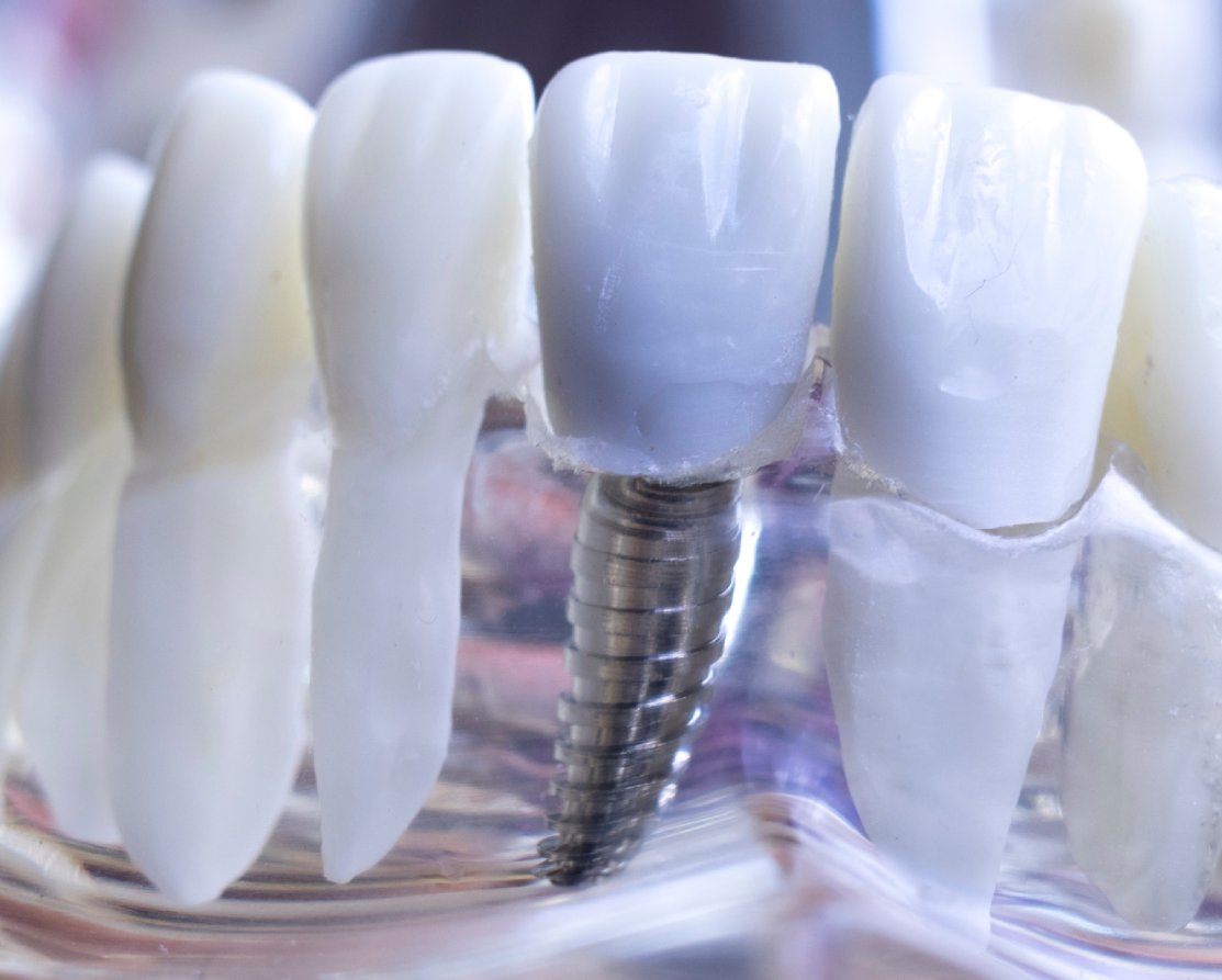 Impianti Dentali Fissi | Studio Dentistico Demetra