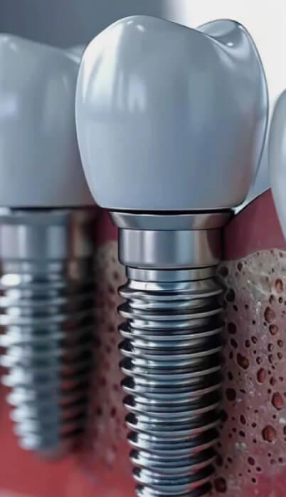 Impianti Dentali | Studio Dentistico Demetra