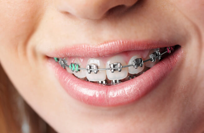Ortodonzia per Adulti | Studio Dentistico Demetra
