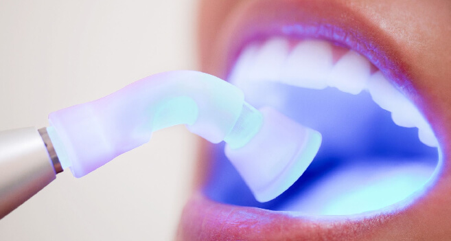 Otturazioni Carie | Studio Dentistico Demetra