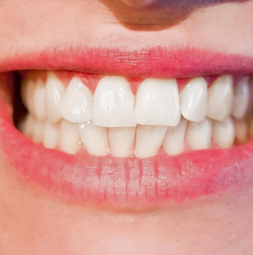 Ricostruzione dei Denti | Studio Dentistico Demetra