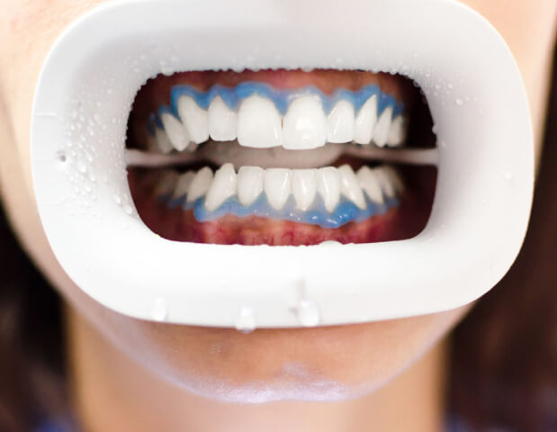 Sbiancamento Dentale | Studio Dentistico Demetra